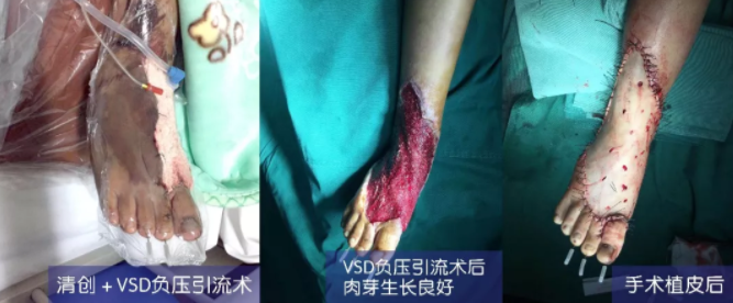 車禍猛如虎，救治如“華佗” ，手術(shù)＋康復(fù)，8歲小女孩車禍后日漸康復(fù)行走