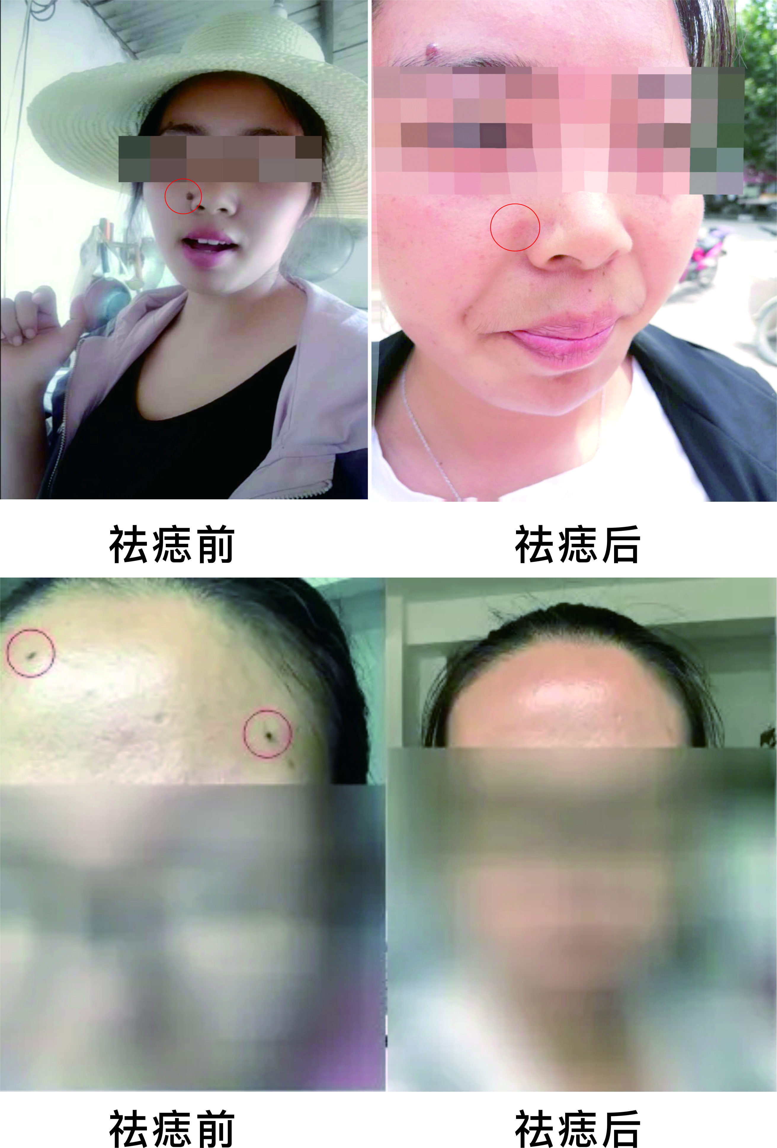 微波祛痣，告別臉部多余的“點(diǎn)綴”~