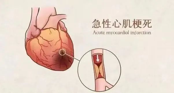 【保山安利醫(yī)院】11月20日“心梗救治日” 時(shí)間就是心肌，時(shí)間就是生命！